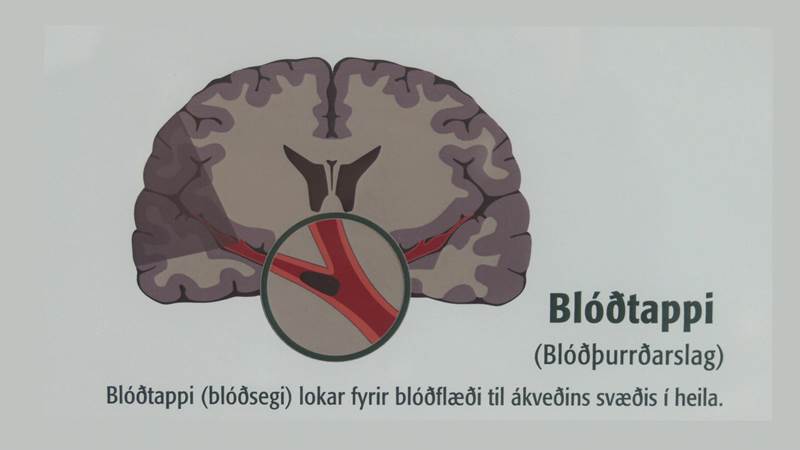 Verum meðvituð um einkenni heilaslags (myndskeið)